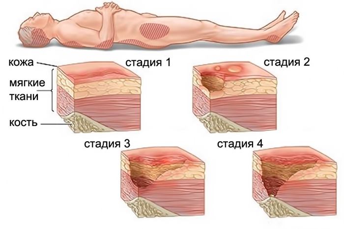 Как возникают пролежни Как возникают пролежни