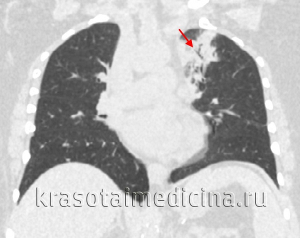 КТ ОГК. Участок пневмонической инфильтрации в верхней доле левого легкого. КТ ОГК. Участок пневмонической инфильтрации в верхней доле левого легкого.