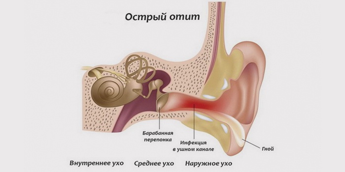 Что за заболевания острый отит