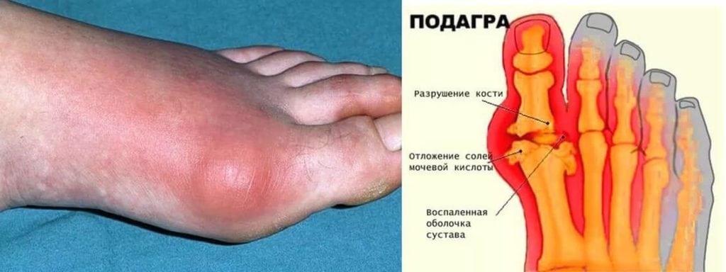 Лечение пиявками при подагре отзывы