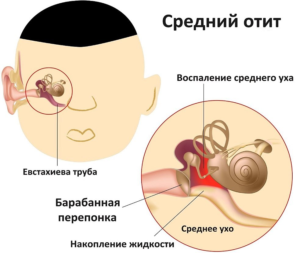 Чем лечить отит при аденоидах