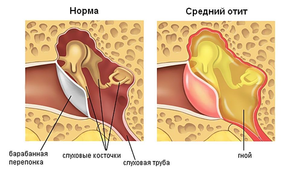Что за заболевания острый отит
