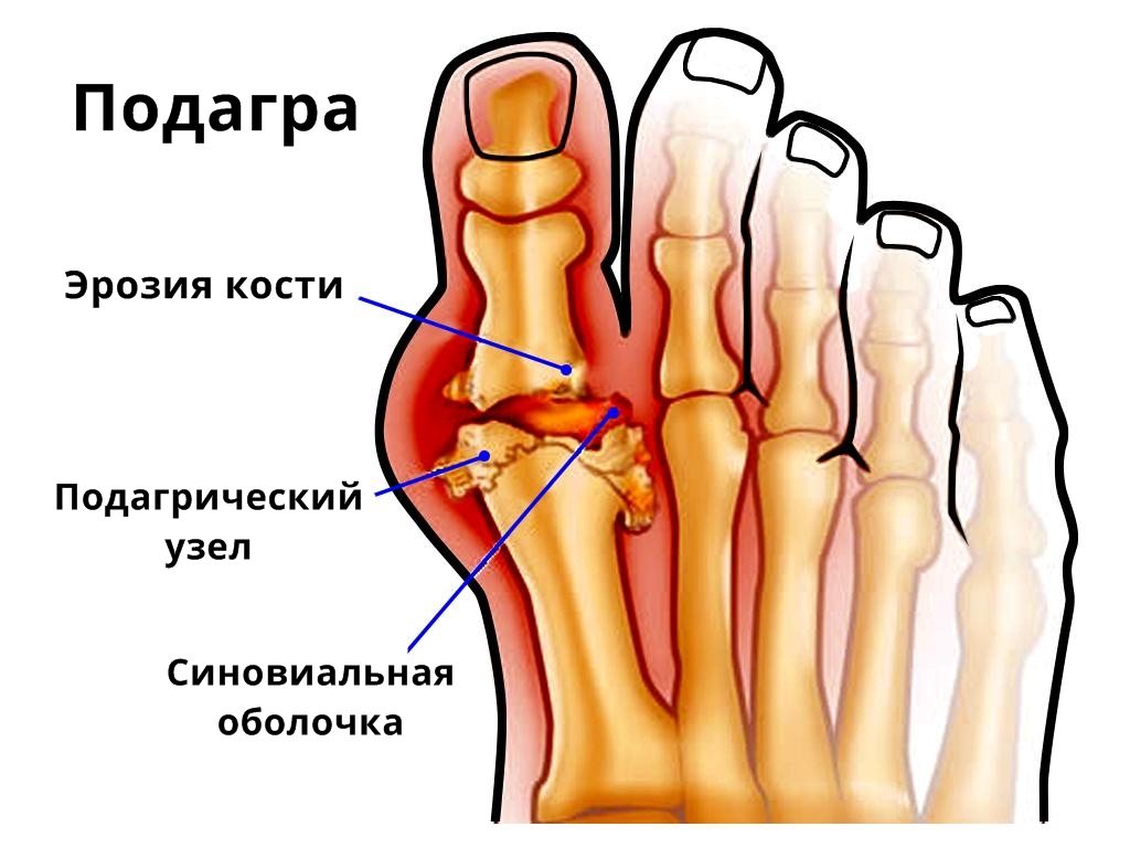 Мазь фулфлекс от подагры инструкция