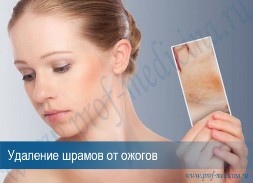 Лазерное удаление рубцов после ожога