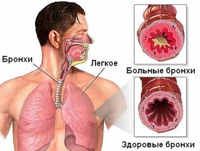 Бронхит