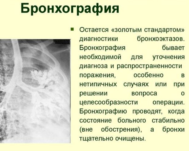Бронхография