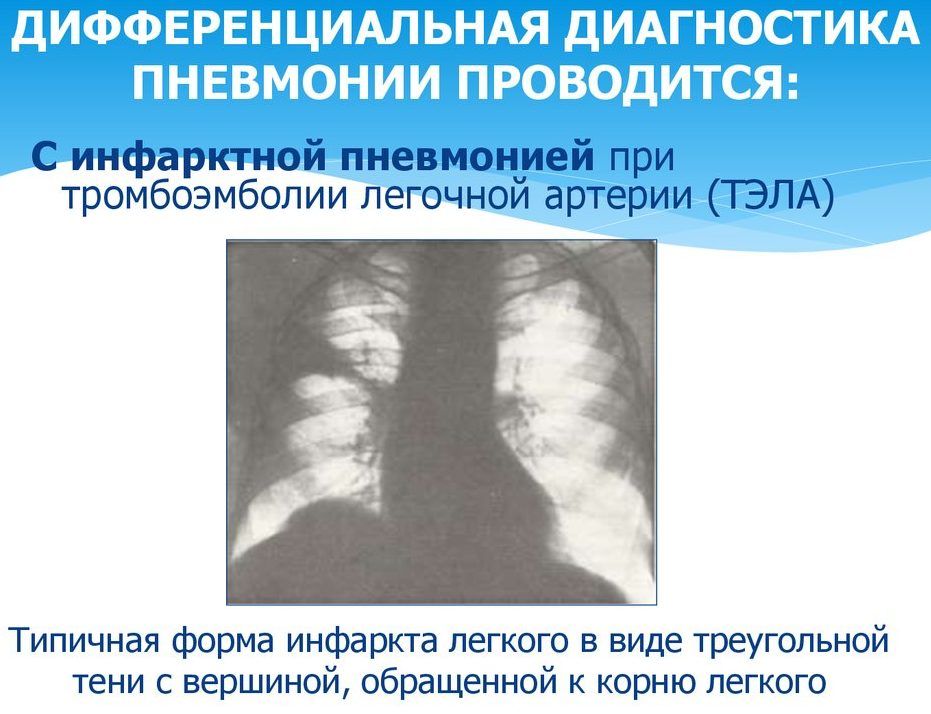 Инфарктную пневмонию