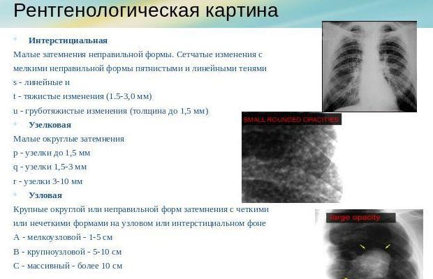 Острая пневмония лечение у ребенка 1 год Острая пневмония лечение у ребенка 1 год thumbnail