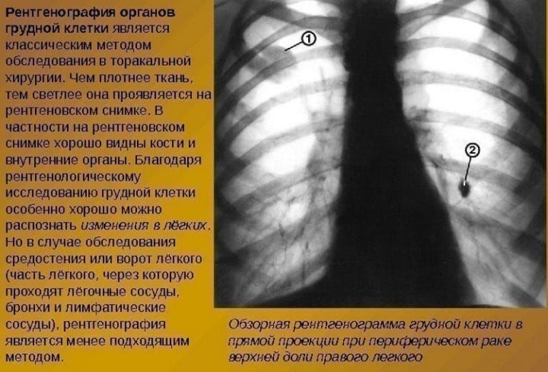 Рентгенография для диагностики пневмонии