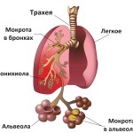 Схема пневмонии Схема пневмонии