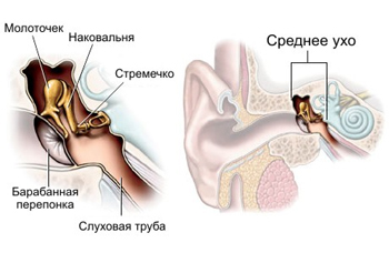 Что такое отит головного мозга