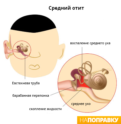средний отит.jpg схема возникновения среднего отита