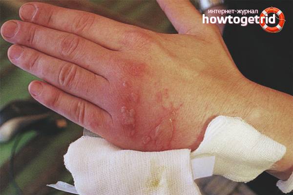 Помощь при ожоге если боль не проходит Помощь при ожоге если боль не проходит thumbnail