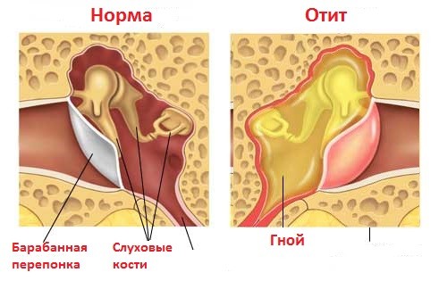 Хронический отит Хронический отит
