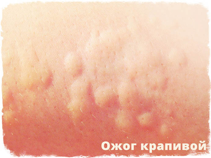 Ожог крапивой Ожог крапивой
