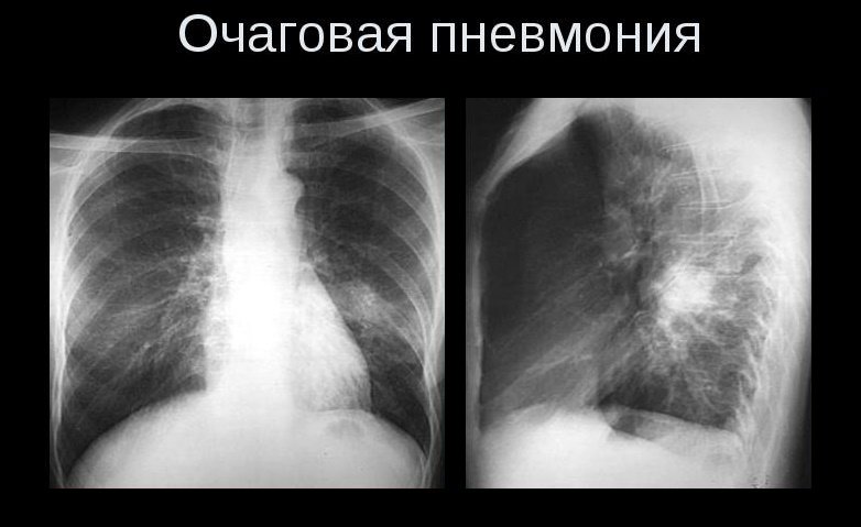 Пневмония