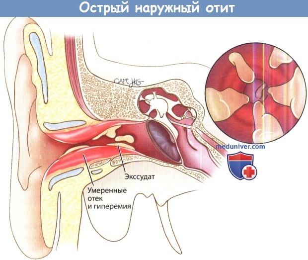 Острый наружный отит