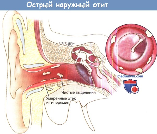 Острый наружный отит