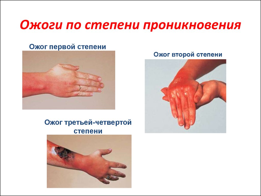 Чем мазать место ожога на коже