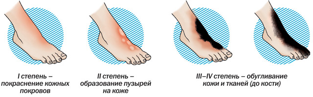 При ожоге можно в баню после