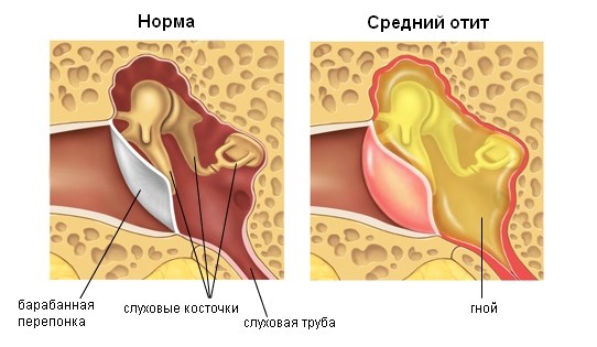 Экссудативный острый средний отит лечение