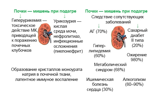Поражение почек при подагре Поражение почек при подагре