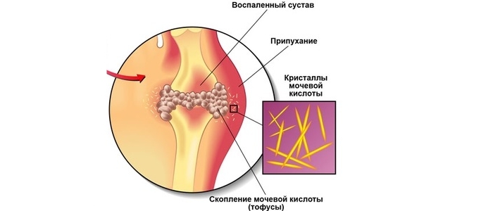 Схема подагры Схема подагры