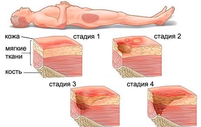 Стадии пролежни