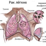 Рак легких Рак легких