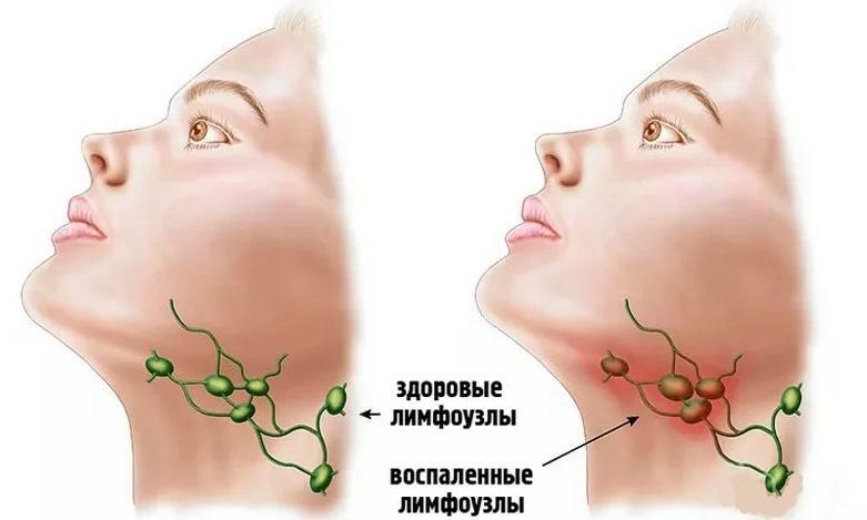 Лимфоузлы шейного отдела