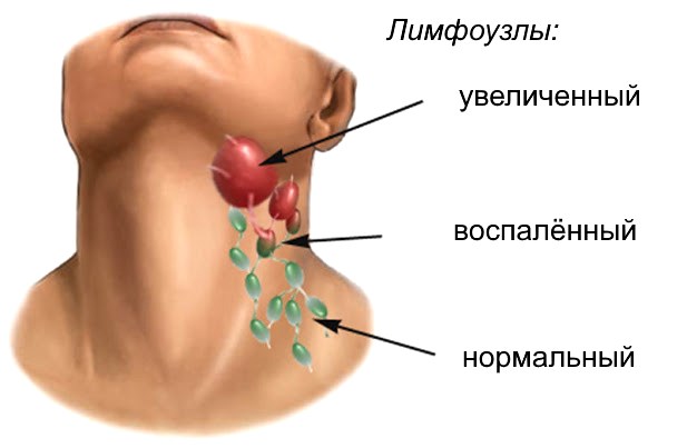 увеличение лимфоузла